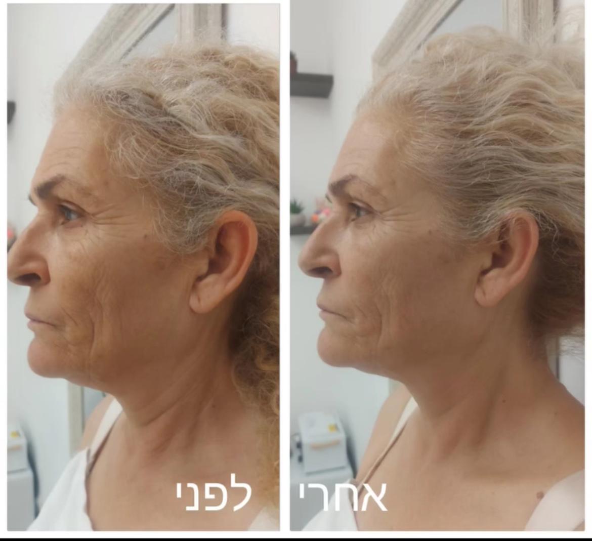 לפני ואחרי 1
