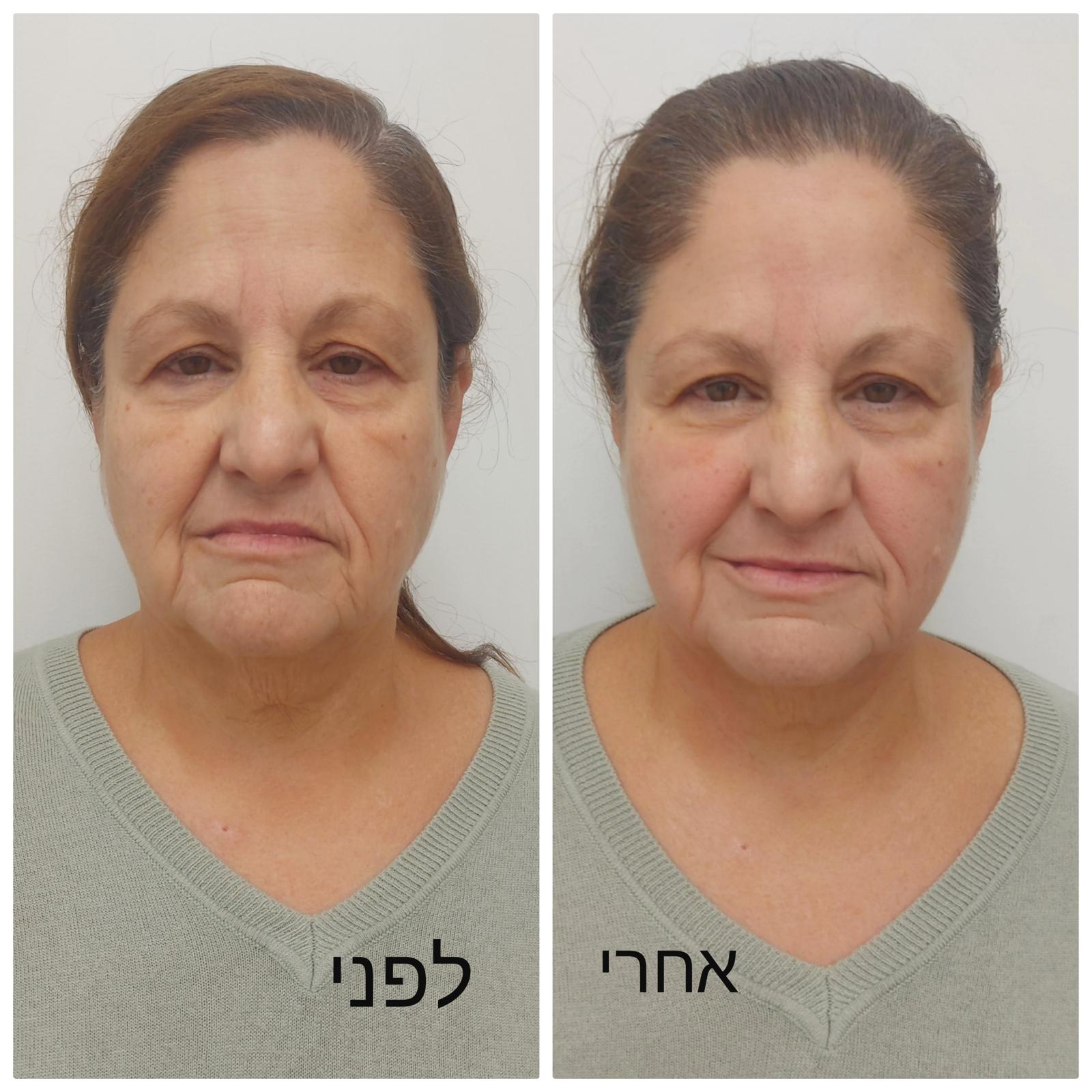 לפני ואחרי 3